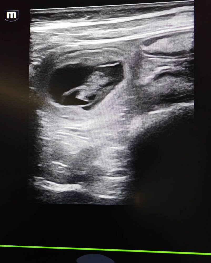 Ultralydsscanning med to fostersække side om side